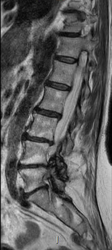 File:Chronic spinal hematoma with cauda equina syndrome (Radiopaedia 75745-87090 Sagittal T2 5).png