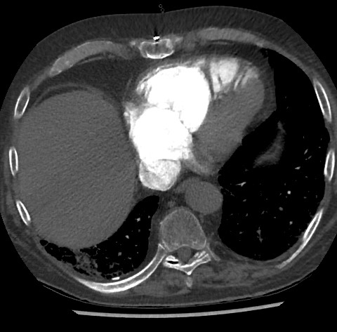 File:Chronic thromboembolic pulmonary disease (Radiopaedia 90694-108119 Axial C+ CTPA 73).jpg