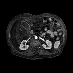 Cirrhosis and hepatocellular carcinoma in the setting of hemochromatosis (Radiopaedia 75394-86594 Axial T1 C+ fat sat 109).jpg