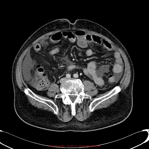 File:Cirrhosis and hepatocellular carcinoma in the setting of hemochromatosis (Radiopaedia 75394-86595 B 57).jpg
