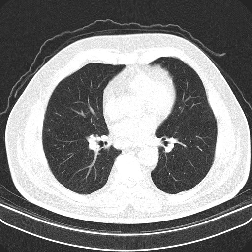 File:Classic complicated silicosis (Radiopaedia 49720-54961 Axial lung window 32).jpg