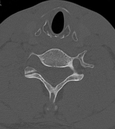 Clay-shoveler fracture (Radiopaedia 14604-14532 Axial bone window 9).jpg