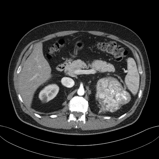 File:Clear cell renal cell carcinoma (Radiopaedia 61449-69393 B 22).jpg