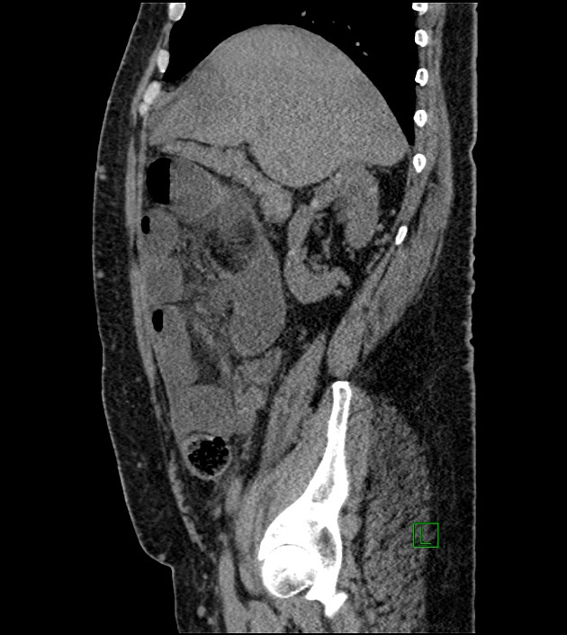 Closed-loop small bowel obstruction-internal hernia (Radiopaedia 78439-91096 C 101).jpg