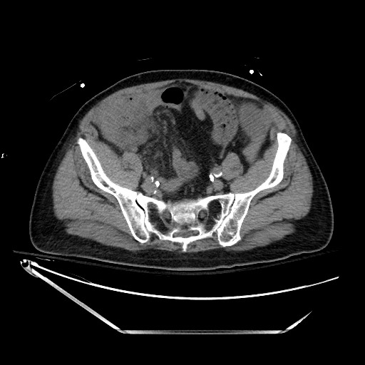 Closed loop obstruction due to adhesive band, resulting in small bowel ischemia and resection (Radiopaedia 83835-99023 Axial non-contrast 117).jpg