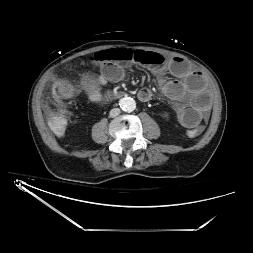 File:Closed loop obstruction due to adhesive band, resulting in small bowel ischemia and resection (Radiopaedia 83835-99023 D 85).jpg