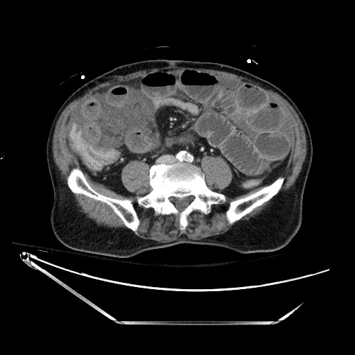 Closed loop obstruction due to adhesive band, resulting in small bowel ischemia and resection (Radiopaedia 83835-99023 D 97).jpg