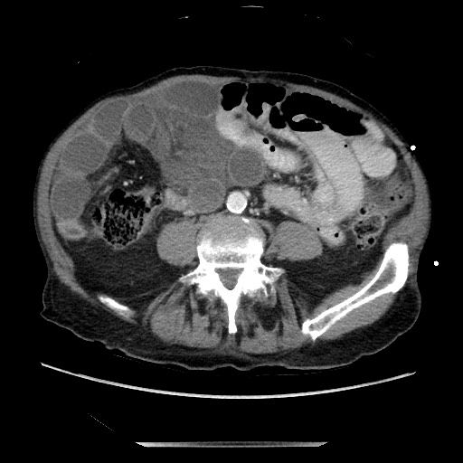 File:Closed loop small bowel obstruction - adhesive disease and hemorrhagic ischemia (Radiopaedia 86831-102990 A 117).jpg