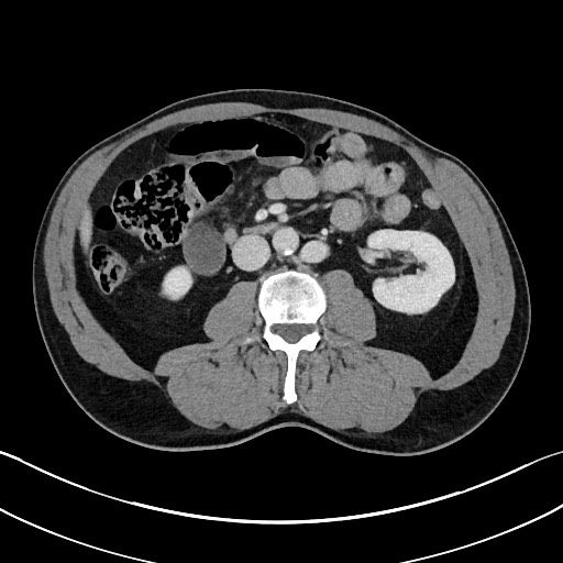 Closed loop small bowel obstruction - internal hernia (Radiopaedia 57806-64778 B 59).jpg