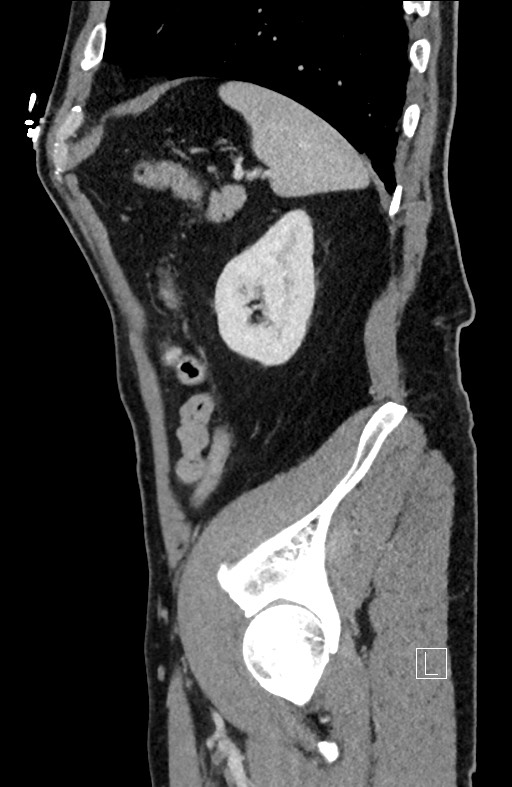 Closed loop small bowel obstruction - internal hernia (Radiopaedia 57806-64778 C 27).jpg