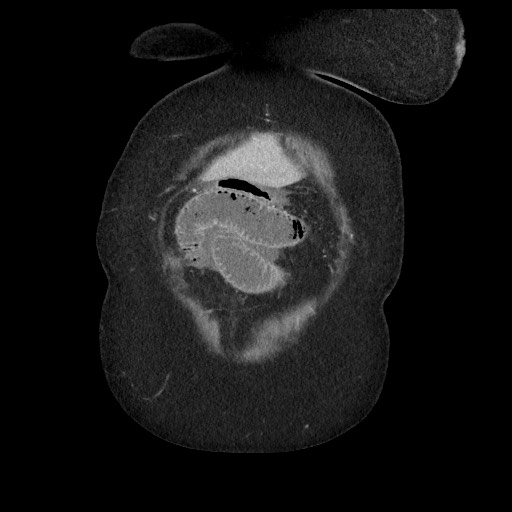 Closed loop small bowel obstruction - internal hernia (Radiopaedia 65402-74450 B 13).jpg