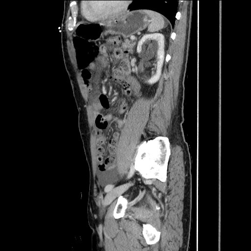 Closed loop small bowel obstruction - omental adhesion causing "internal hernia" (Radiopaedia 85129-100682 C 122).jpg