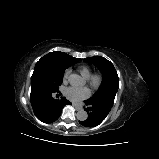 Closed loop small bowel obstruction due to adhesive band, with intramural hemorrhage and ischemia (Radiopaedia 83831-99017 Axial non-contrast 5).jpg