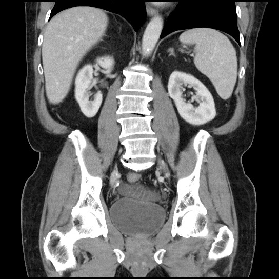 File:Closed loop small bowel obstruction due to adhesive band - U-shaped loop (Radiopaedia 83829-99012 B 32).jpg