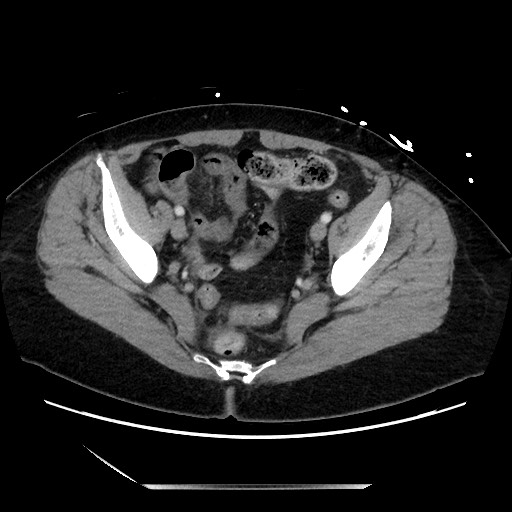 Closed loop small bowel obstruction due to adhesive bands - early and late images (Radiopaedia 83830-99014 A 127).jpg