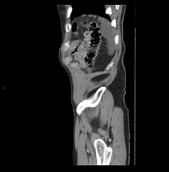 Closed loop small bowel obstruction with ischemia (Radiopaedia 84180-99456 C 83).jpg