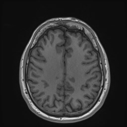 File:Cochlear incomplete partition type III associated with hypothalamic hamartoma (Radiopaedia 88756-105498 Axial T1 134).jpg