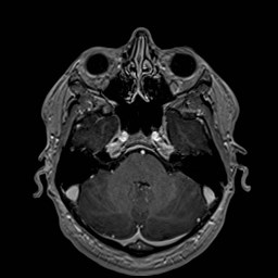 Cochlear incomplete partition type III associated with hypothalamic hamartoma (Radiopaedia 88756-105498 Axial T1 C+ 62).jpg