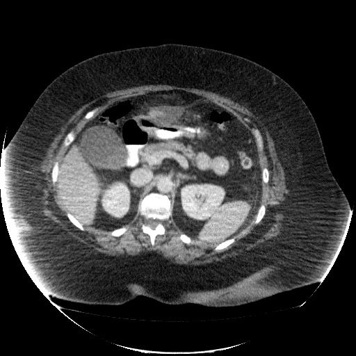 File:Collection due to leak after sleeve gastrectomy (Radiopaedia 55504-61972 A 30).jpg