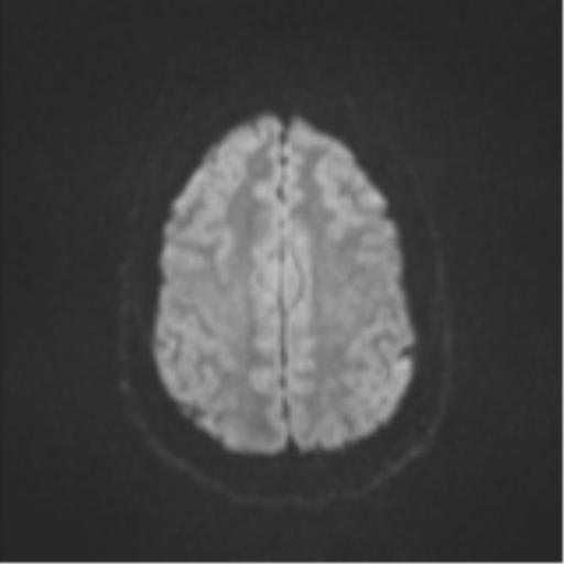 Colloid cyst (Radiopaedia 44510-48181 Axial DWI 50).png