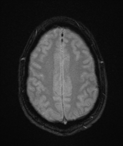File:Colloid cyst (Radiopaedia 44510-48181 Axial Gradient Echo 21).png