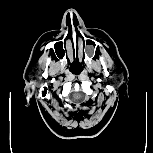 File:Colloid cyst (large) (Radiopaedia 34415-35734 Axial non-contrast 7).png