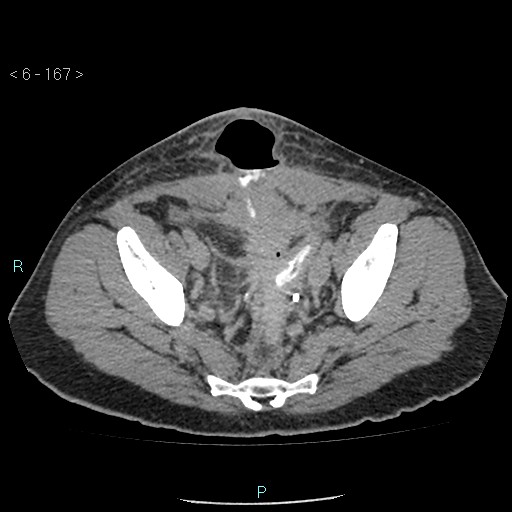 Colo-cutaneous fistula (Radiopaedia 40531-43129 A 69).jpg