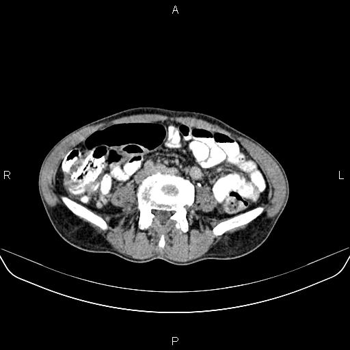 File:Colon adenocarcinoma - hepatic flexure (Radiopaedia 85635-101395 Axial C+ delayed 58).jpg