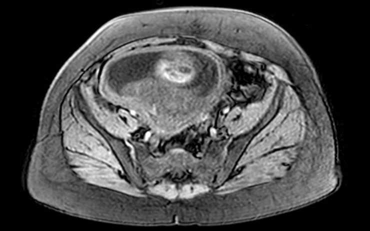 Colon adenocarcinoma with Krukenberg tumors, advanced pregnancy (Radiopaedia 67279-76645 A 24).jpg