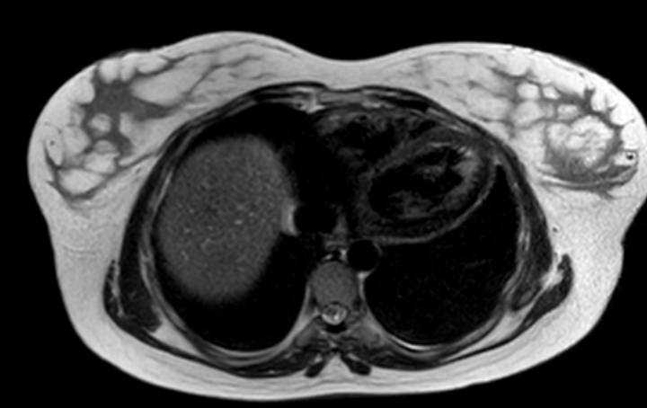 Colon adenocarcinoma with Krukenberg tumors, advanced pregnancy (Radiopaedia 67279-76645 Axial T2 81).jpg