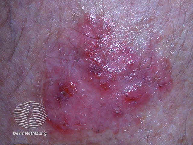Intraepidermal carcinoma (DermNet NZ lesions-scc-in-situ-2912).jpg