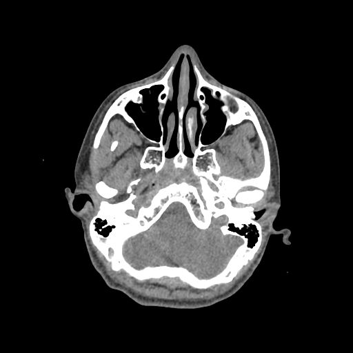 Nasal pyogenic granuloma (lobular capillary hemangioma) (Radiopaedia 85536-101244 Axial non-contrast 67).jpg