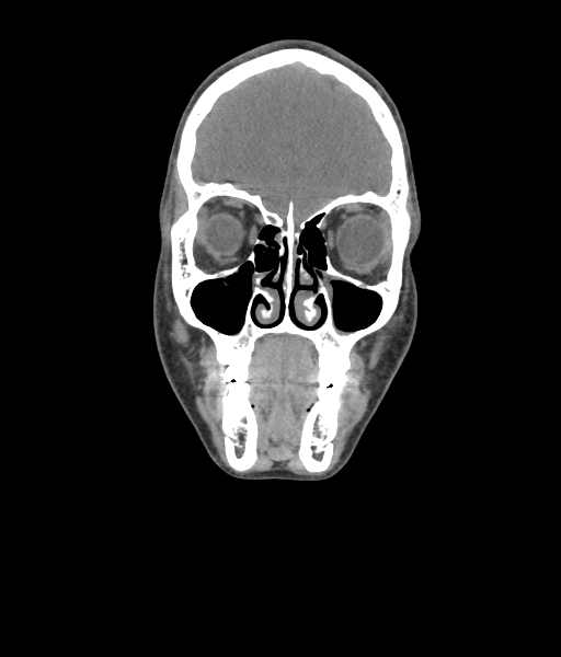 Nasal pyogenic granuloma (lobular capillary hemangioma) (Radiopaedia 85536-101244 Coronal non-contrast 71).jpg