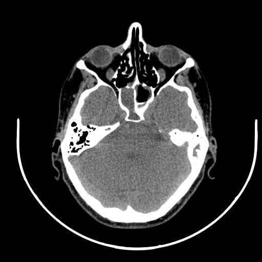 Nasopharyngeal carcinoma - infiltrating the clivus (Radiopaedia 62583-70875 Axial non-contrast 6).jpg