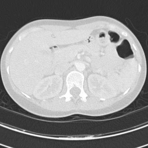 Necrobiotic pulmonary nodules - Crohn disease (Radiopaedia 20723-20631 Axial lung window 149).jpg