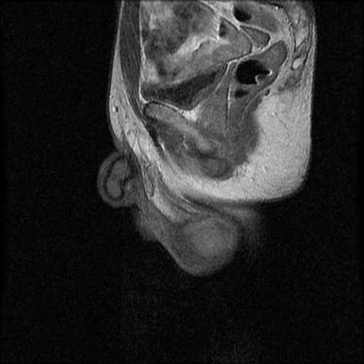File:Necrotizing epididymo-orchitis with intra-testicular abscess (Radiopaedia 29397-29860 Sagittal T1 C+ 8).jpg