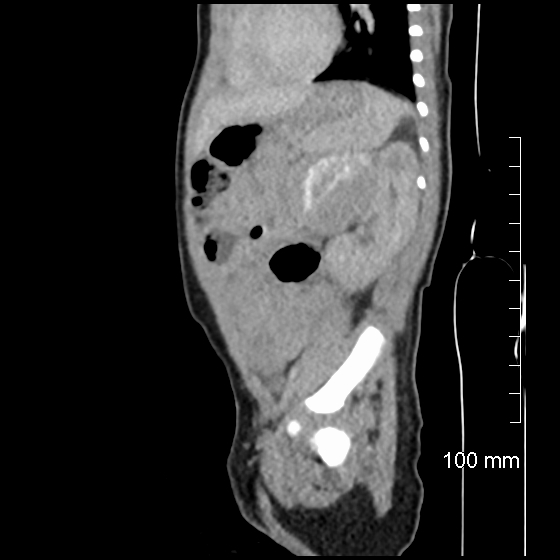 File:Neonatal neuroblastoma (Radiopaedia 56651-63438 C 33).jpg