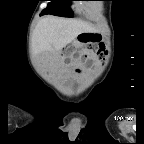 File:Neonatal neuroblastoma (Radiopaedia 56651-63438 Coronal non-contrast 11).jpg