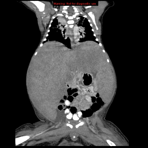 File:Neonatal neuroblastoma (Radiopaedia 9564-10223 B 73).jpg
