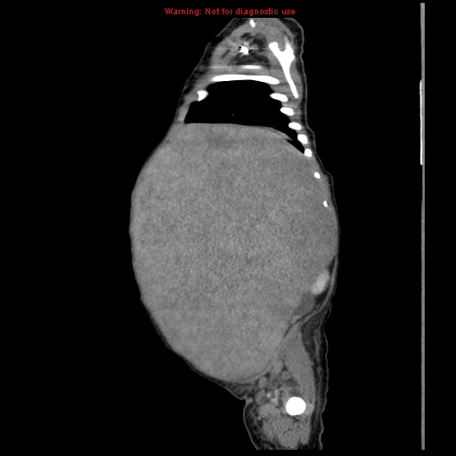 File:Neonatal neuroblastoma (Radiopaedia 9564-10223 C 34).jpg