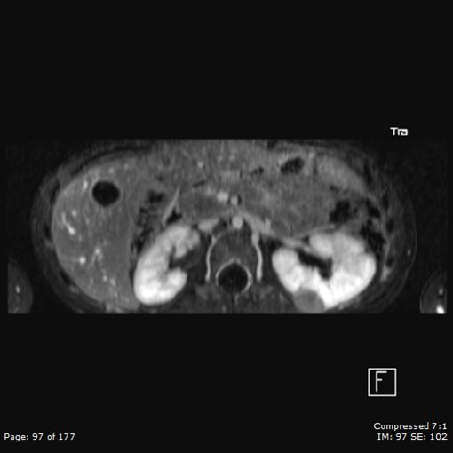 File:Nephroblastomatosis (Radiopaedia 39984-42478 Axial T1 C+ fat sat 1).png