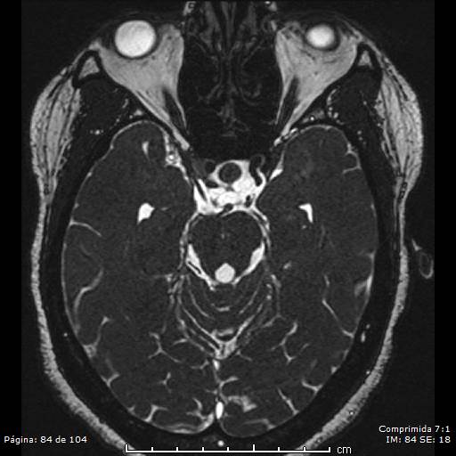 Neurocysticercosis (Radiopaedia 58636-65832 I 84).jpg