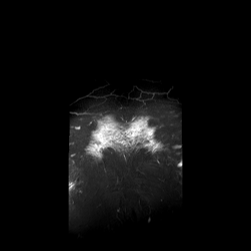 File:Neurofibromatosis type 1- extensive spinal involvement and Christmas tree sign (Radiopaedia 60610-68332 Coronal STIR 20).jpg