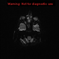 File:Neurofibromatosis type 1 with optic nerve glioma (Radiopaedia 16288-15965 Axial DWI 43).jpg