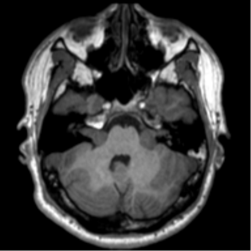 File:Neurofibromatosis type 2 (Radiopaedia 44936-48838 Axial T1 30).png