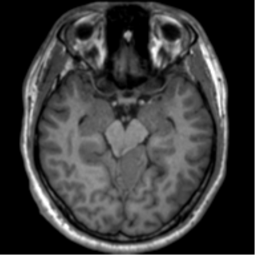 File:Neurofibromatosis type 2 (Radiopaedia 44936-48838 Axial T1 53).png