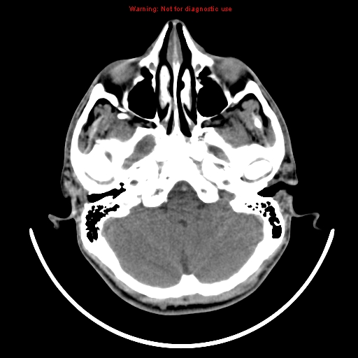 File:Neurofibromatosis type 2 (Radiopaedia 8953-9732 Axial non-contrast 5).jpg
