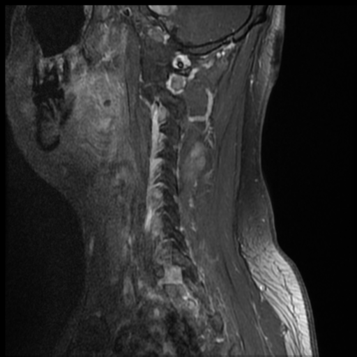 File:Neurofibromatosis type 2 (spinal manifestations) (Radiopaedia 53943-60070 G 2).png