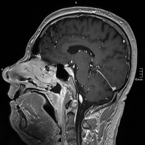 Neurosarcoidosis - involvement of the mesial temporal lobes (Radiopaedia 67429-76820 Sagittal T1 C+ 78).jpg