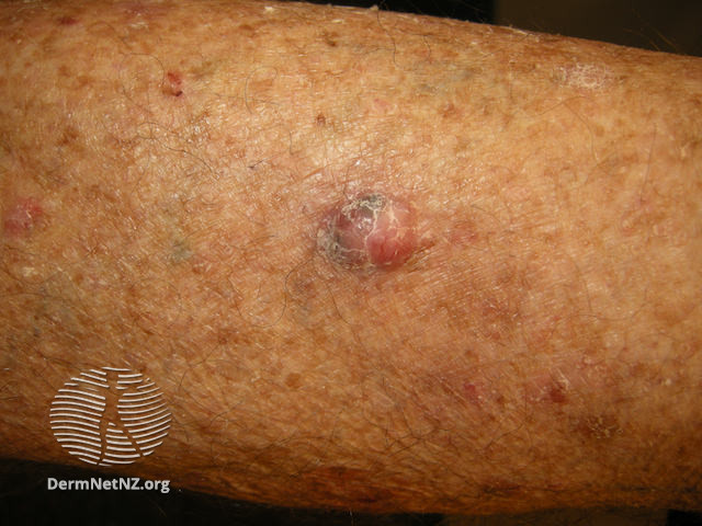 File:Nodular basal cell carcinoma, leg (DermNet NZ nbcc-leg-22-dn).jpg